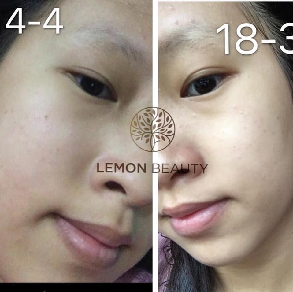 Elbeans82Jose's tweet photo. Feedback chân thật: sau 4 tuần chăm sóc, tình trạng mụn ẩn và mụn bọc đã cải thiện rõ rệt. Công thức đơn giản, tiện lợi tại nhà, phù hợp nhiều loại da. https://t.co/cxwdrk97DO