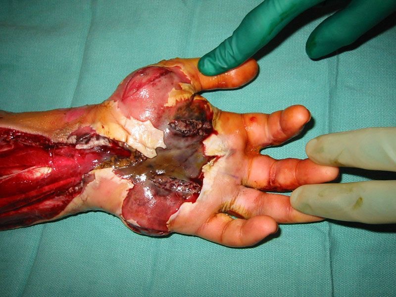 undeadunwilling's tweet photo. Sfx
#goretwt #morbidtwt

Fasciotomy to relieve pressure from a snake bite https://t.co/Bq90eQAMVB