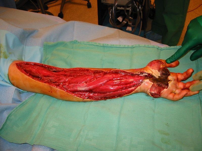 undeadunwilling's tweet photo. Sfx
#goretwt #morbidtwt

Fasciotomy to relieve pressure from a snake bite https://t.co/Bq90eQAMVB