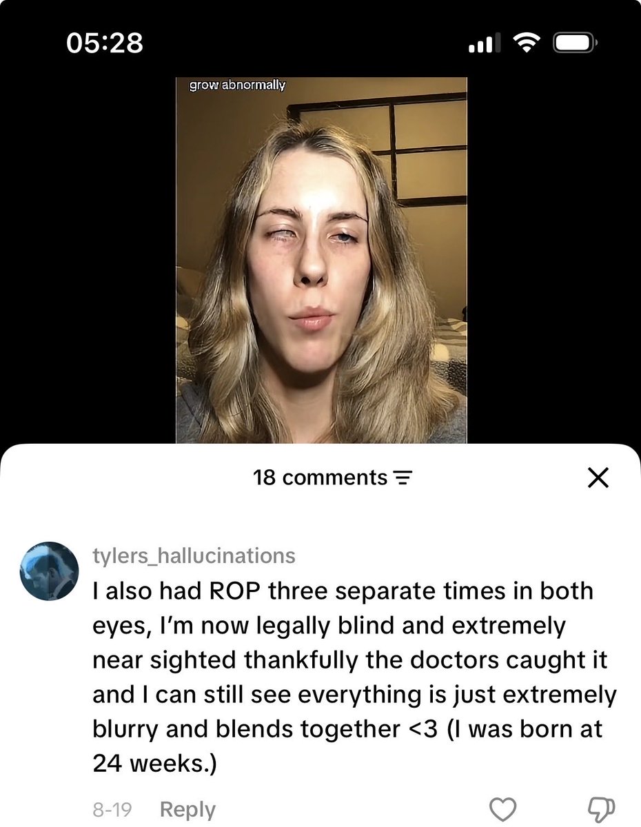 _khalif_07's tweet photo. You know what’s shocking? 

65% of ROP ( retinopathy of prematurity)  cases occur in LMICs where pediatric ophthalmologists are scarce. 

So meaning lots of children go blind in our settings and they could have been treated.🥲

Truly the work continues @moore_uki 💪 https://t.co/ChbJsJmIqX