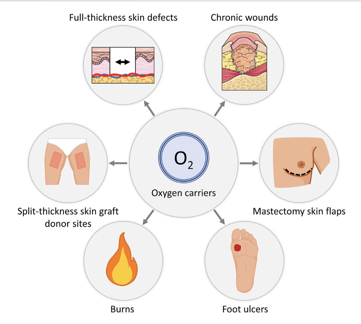 Hemarina's tweet photo. How can we bring oxygen to tissues when blood circulation is severely compromised?

Among the technologies reviewed in this scientific paper, is M101, the extracellular hemoglobin of the marine lugworm Arenicola marina 🪱, and HEMHealing®, our M101-based oxygenating hydrogel.

Among the authors is Professor Yves Harder  from Lausanne University Hospital (CHUV / Centre hospitalier universitaire vaudois ), the head of plastic and reconstructive surgery and burn care who was in frontline with his team to treat the burn victims of Crans-Montana.

Indeed, M101 can carry up to 156 oxygen molecules and release oxygen according to the local oxygen gradient. The authors  also highlight its intrinsic antioxidant properties.

The paper discusses our first clinical observations in severe burns, including a patient with burns covering 85% of total body surface area. Because donor sites were extremely limited, HEMHealing® was applied to second-degree burns on the chest, abdomen and back. After six weeks, the burn area in these treated regions had been reduced to less than 2%. 

What particularly struck me is the authors’ conclusion .

Despite emphasizing that larger randomized clinical trials are now essential, they state that M101’s markedly elevated oxygen-carrying capacity positions it as:

“the most promising candidate”

Nearly 30 years ago, when I began studying the extraordinary respiratory adaptations of a marine worm, I could never have imagined where this research might lead.

Today, we are exploring whether a molecular solution developed by evolution to survive hypoxia could help physicians oxygenate and preserve severely damaged human tissues.

That is what biomimicry means to me: not simply being inspired by nature, but understanding its solutions deeply enough to transform them into medicine.

The early clinical observations are encouraging and a clinical trial needs to be conducted under the Medical Device regulation, since until this summer ANSM recongnize the legal status of HEMHealing.

HEMHealing answer to the framework of a medical device.

From a marine worm to severe burns, sometimes the future of medicine begins where we least expect it.

#HEMARINA #HEMHealing #M101 #BurnCare #WoundHealing #Oxygen #Biomimicry #Biotechnology #RegenerativeMedicine

👉🗞️ doi: 10.3389/fbioe.2026.1938458