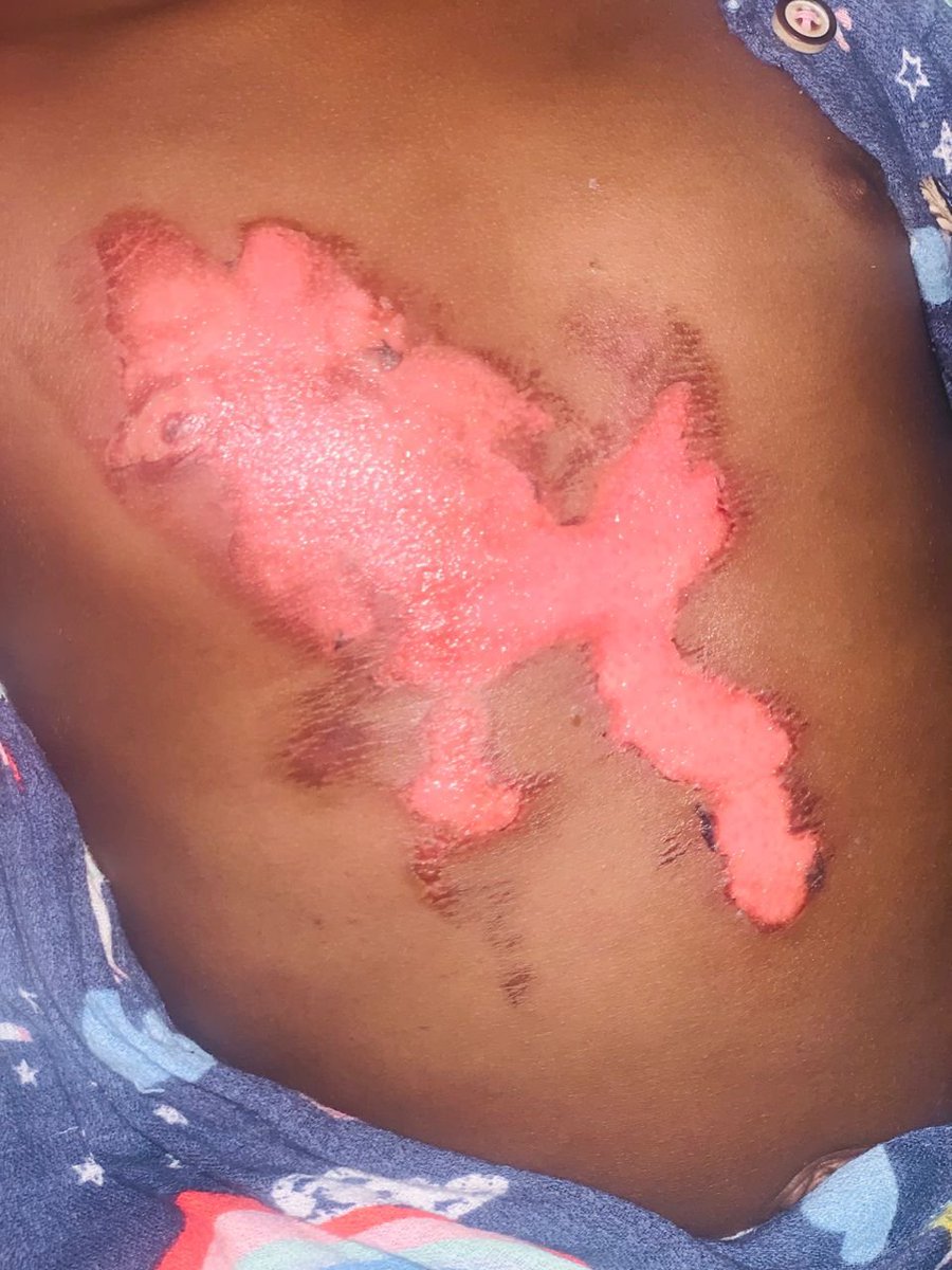 Esther290354929's tweet photo. Today makes it exactly one month since hot water scalded my 24-month-old baby. 😢

The fear and helplessness I felt that day are still so fresh. But seeing her all healed up today, I can only say, THANK YOU, JESUS. 😭🙏🏽

God protected her, God healed her, and I’m forever grateful. ❤️