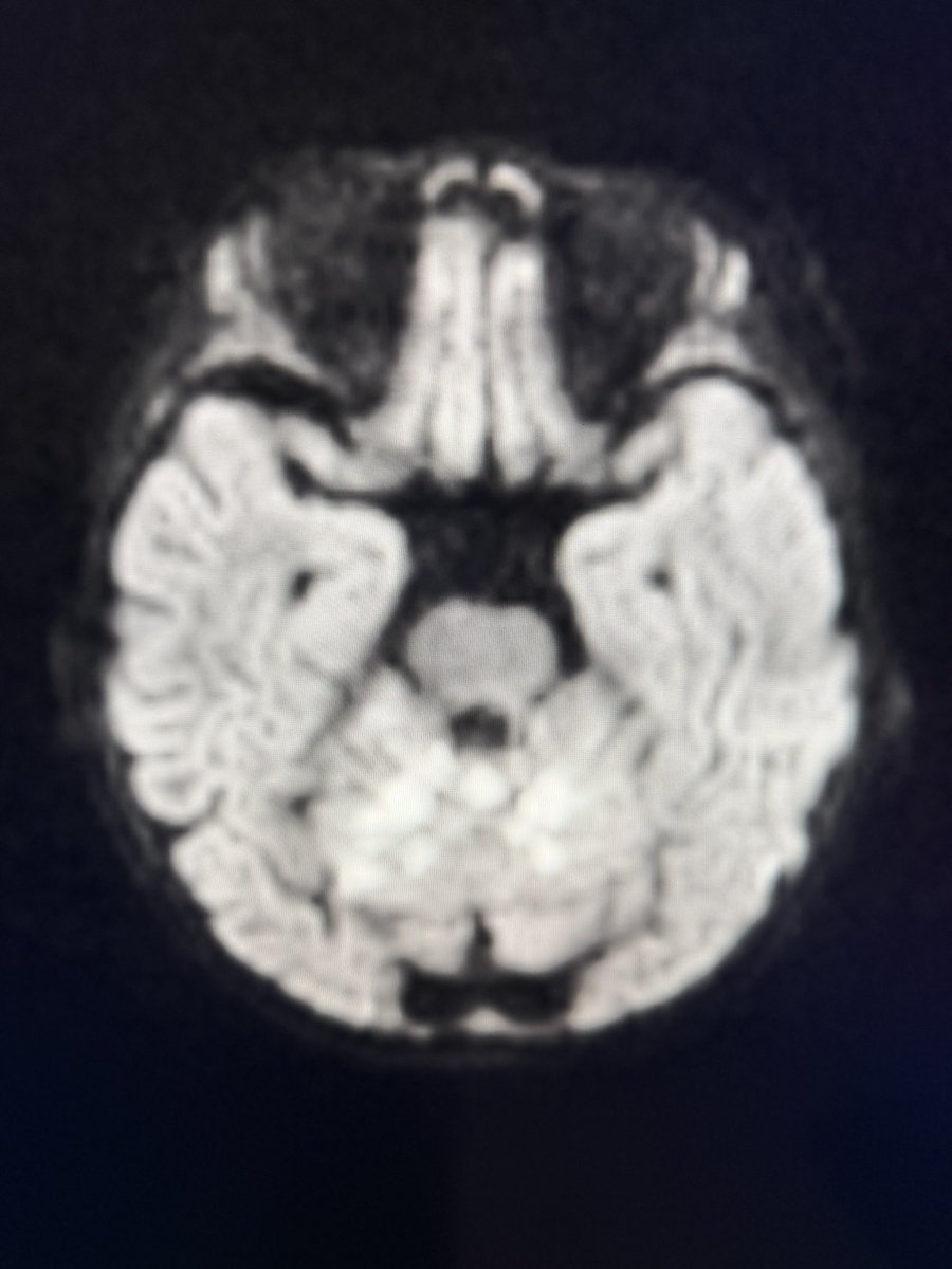 drmankad's tweet photo. Top tip 💡: Anemia remains a leading cause of stroke, not restricted to the poorer population of the world. Severe anemia increases thrombotic risk significantly! Let’s proactively tackle this treatable cause, from social, economic and medical perspectives. We all have an important part to play!