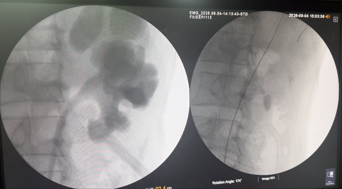 PrajwalPaudyal's tweet photo. An inferiorly and medially directed calyx poses a significant technical challenge for percutaneous access during supine PCNL..this is a pyelogram after stone clearance in inferior medial calyceal stone https://t.co/Dae1uMoFUM