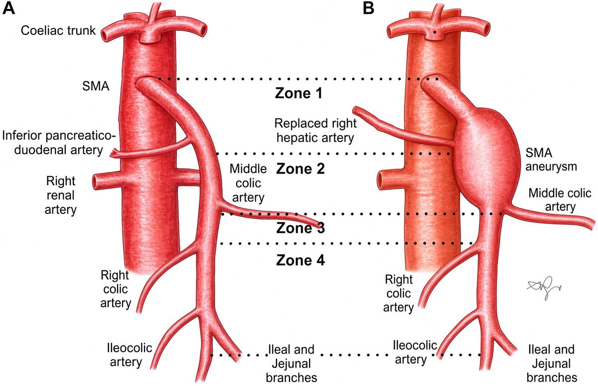 PipeCabreraV's tweet photo. The zone 1 and 2 of Fullen! The superior mesenteric artery anatomy! @pferrada1 @SWexner @AmCollSurgeons @TomVargheseJr @BJSAcademy @CiruAndes2 https://t.co/m8yW0fKWLn