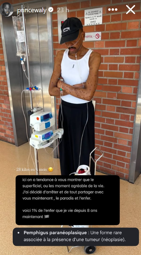 Synapse_Med's tweet photo. Il y a quelques jours, Prince Waly a annoncé être atteint d’un pemphigus paranéoplasique, une maladie auto-immune particulièrement sévère.

L'histoire de sa maladie est un cas médical complexe, qui mérite quelques explications.

Tout commence en 2019. Un matin, Prince Waly se réveille et perd sa voix. Au départ, rien ne semble particulièrement inquiétant, mais deux semaines passent et la voix ne revient pas. Il consulte alors un ORL et une corde vocale paralysée est retrouvée.

Des examens sont réalisés et le diagnostic tombe : un thymome, une tumeur du thymus située dans le médiastin, derrière le sternum. La perte de voix peut s'expliquer par une compression du nerf laryngé récurrent.

Il va alors traverser plusieurs années de traitements, pendant lesquelles la musique est mise entre parenthèses, avant de revenir. 

Mais l'histoire de sa maladie ne s'arrête pas là. 

Certains cancers peuvent se compliquer de syndromes paranéoplasiques : des maladies résultant de la production de substances par la tumeur ou, comme ici, de la réaction anormale du système immunitaire. 

Une manifestation rare est le pemphigus paranéoplasique, une maladie auto-immune particulièrement sévère. Dans cette maladie, le système immunitaire produit des anticorps dirigés contre des protéines impliquées dans l'adhérence entre les cellules de la peau et des muqueuses. Les cellules perdent alors leur cohésion : c'est l'acantholyse. 

Des bulles et des érosions cutanées peuvent apparaître, mais l'atteinte des muqueuses est particulièrement caractéristique : bouche, pharynx, yeux ou parfois organes génitaux. Ces lésions peuvent être extrêmement douloureuses et rendre l'alimentation ou même la déglutition difficiles.

La principale complication à redouter est la bronchiolite oblitérante : les petites bronches s’enflamment puis se fibrosent progressivement, pouvant entraîner une insuffisance respiratoire potentiellement mortelle.

La prise en charge repose sur deux objectifs : contrôler la maladie auto-immune et traiter la tumeur lorsqu'une exérèse est possible. Malgré les progrès thérapeutiques, le pronostic reste sévère, surtout en cas de bronchiolite oblitérante.
