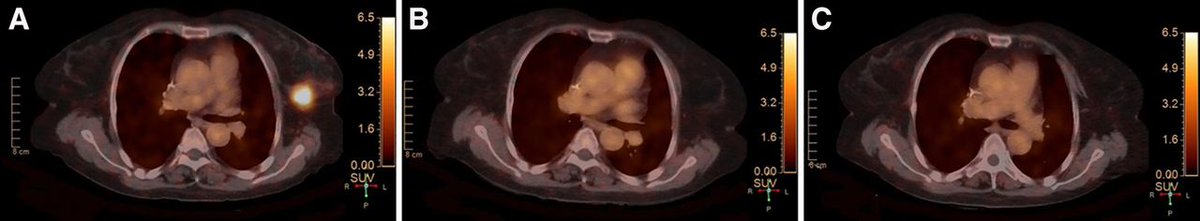 JournalofNucMed's tweet photo. Dynamic changes in ⁶⁸Ga-HER2 PET/CT uptake during neoadjuvant therapy provide an effective early indicator of therapeutic sensitivity in HER2-positive breast cancer. https://t.co/ayx7jdoVqq  

#NuclearMedicine https://t.co/w7xJPgJb8q