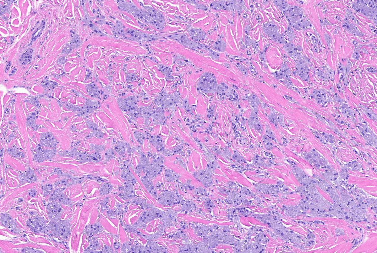 CakePath's tweet photo. 🔬 Granular cell tumor — high-yield pearls
📍 Clinical
• Solitary, slow-growing, firm nodule
• Head/neck common, especially tongue 👅
• Usually benign; malignant tumors are rare
🧫 Histology
• Poorly circumscribed, infiltrative dermal/subcutaneous neoplasm
• Large polygonal cells with abundant coarse eosinophilic granular cytoplasm
• 🔥 Granules = numerous intracytoplasmic lysosomes/autophagolysosomes
• PASD+, diastase-resistant granules (do you know anybody who does it?)
• Cells dissect between collagen bundles and may involve nerves or skeletal muscle
• Overlying pseudoepitheliomatous hyperplasia may mimic SCC ⚠️
🧬 IHC
• Conventional granular cell tumor = Schwannian, S100+/SOX10+
• Non-neural granular cell tumor = non-Schwannian, S100−/SOX10− 
#pathology #pathologists #pathTwitter #dermpath #dermatology #dermtwitter