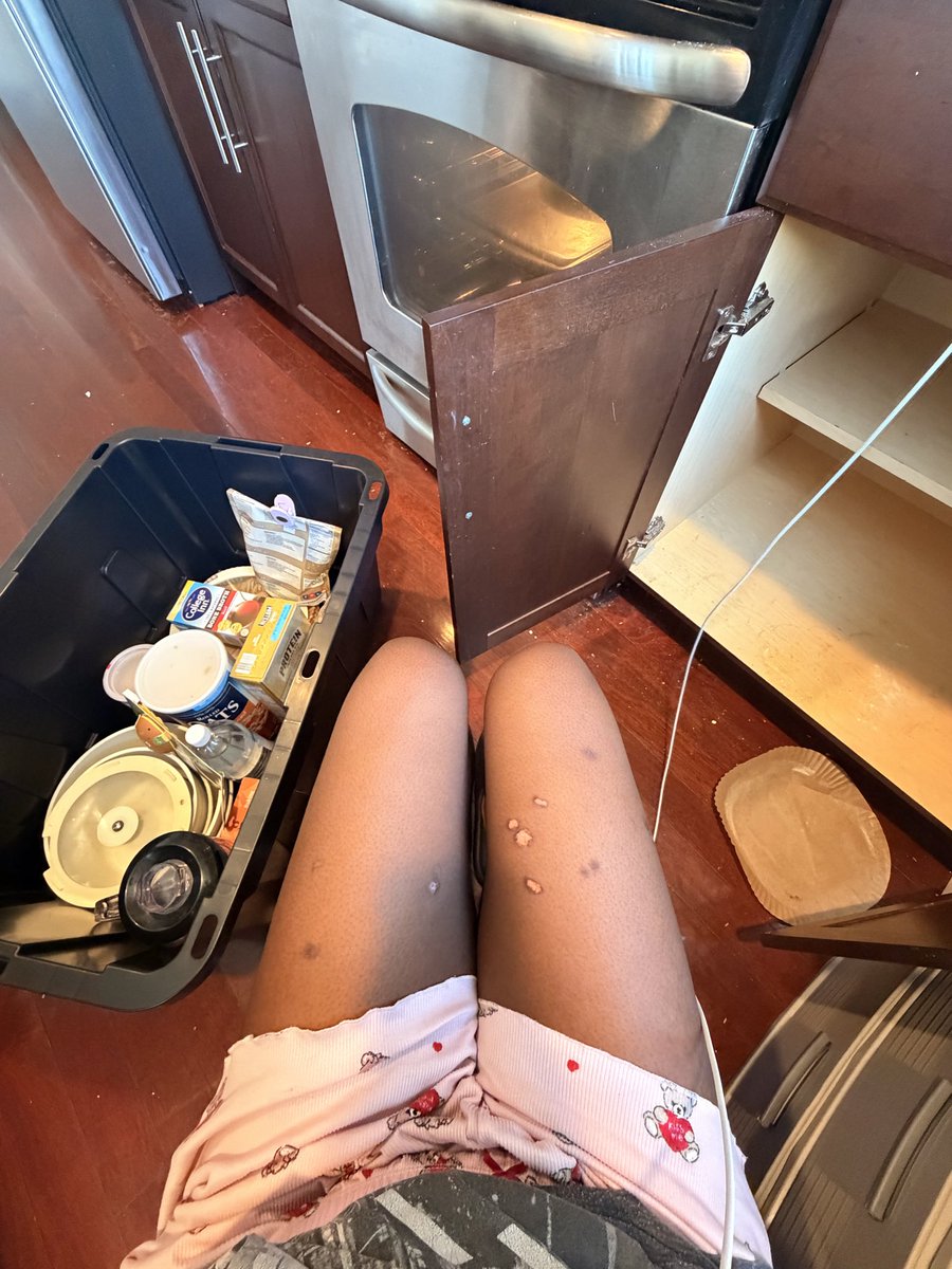 blkwmnstrving's tweet photo. Thighs check as I pack up my kitchen 😬 burns from lighters bc I either couldn’t stop bingeing or my application wasn’t going through https://t.co/PpFDllbBkf