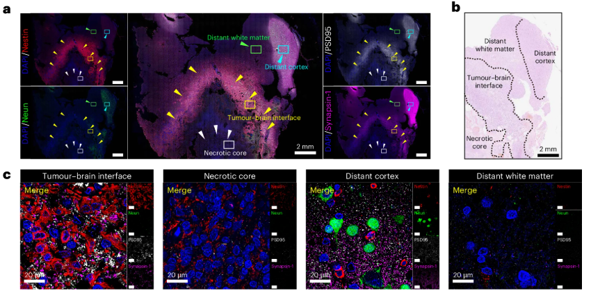 NeuralCell's tweet photo. Researchers have defined the spatial + molecular determinants of malignant synapses by analyzing intact human #glioblastoma specimens. They revealed enrichment of synapse-like structures and synapse-associated gene programs at the tumor–brain interface.

🔬https://t.co/J0oKQ3wM27 https://t.co/WzYHLf6nse