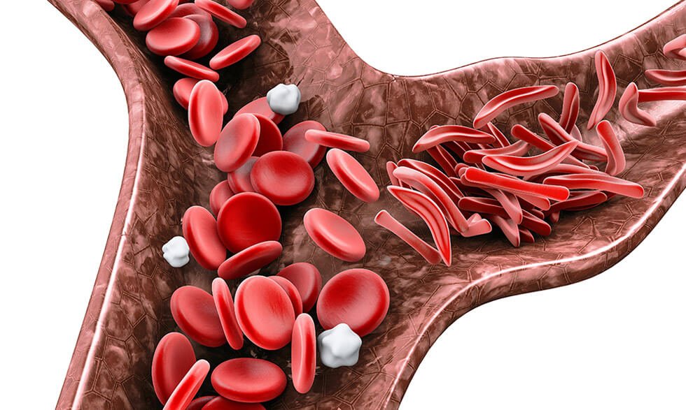 drboakyedanquah's tweet photo. September is Sickle Cell Awareness Month.
In Ghana, thousands of babies are born with sickle cell disease every year. Too many families only find out after a child is already in pain.
Know your genotype — not just before marriage. Before you plan a life.

#KnowYourGenotype #SickleCellAwarenessMonth #BOD #BODcares