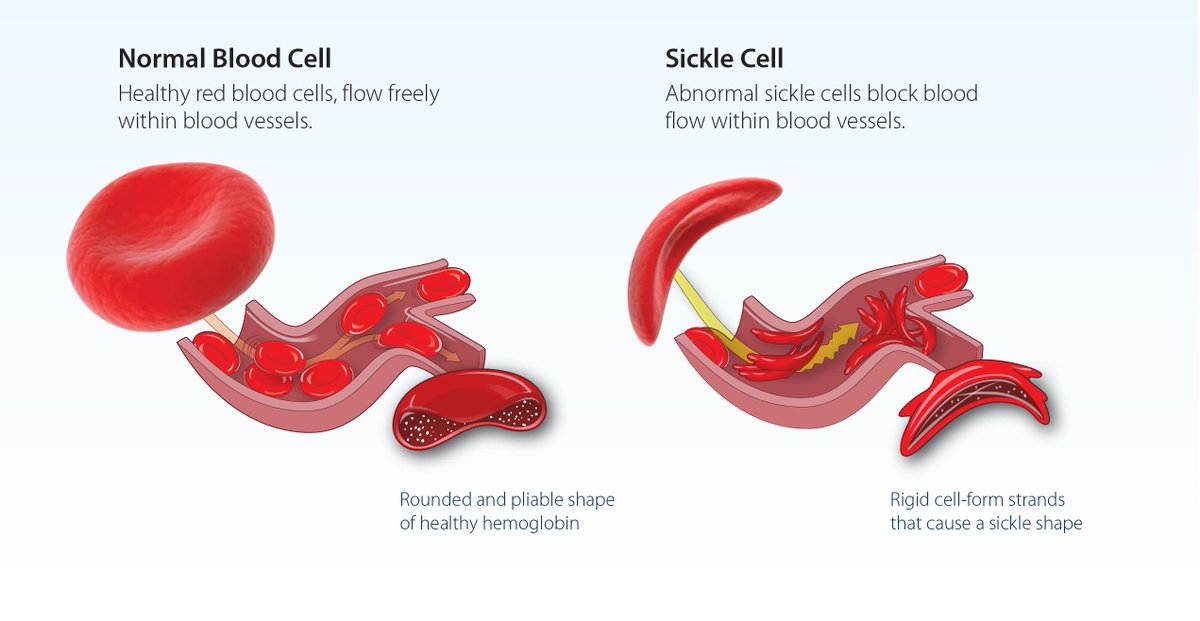 drboakyedanquah's tweet photo. September is Sickle Cell Awareness Month.
In Ghana, thousands of babies are born with sickle cell disease every year. Too many families only find out after a child is already in pain.
Know your genotype — not just before marriage. Before you plan a life.

#KnowYourGenotype #SickleCellAwarenessMonth #BOD #BODcares