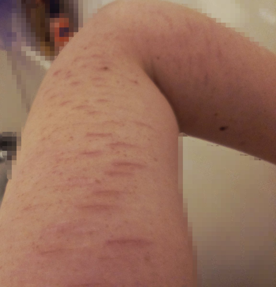 bug_fishhh's tweet photo. Scars! !FAKE SFX MAKEUP! https://t.co/8hkFx3EGaL