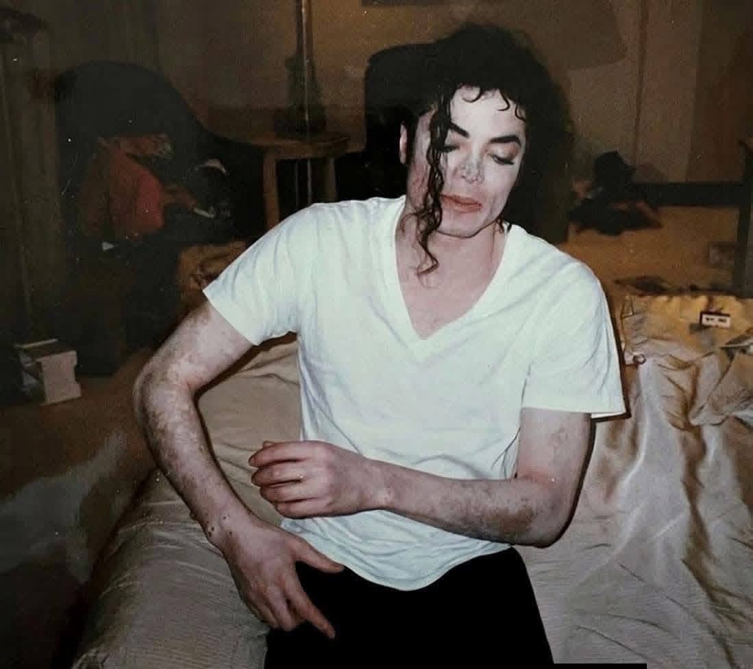 jacksncntrl's tweet photo. @haterkid1 @michaeljackson Michael had universal vitiligo , this is is why 95% of his body was covered in white patches , He was &amp; is black, period. https://t.co/HG0E4Wo9jM