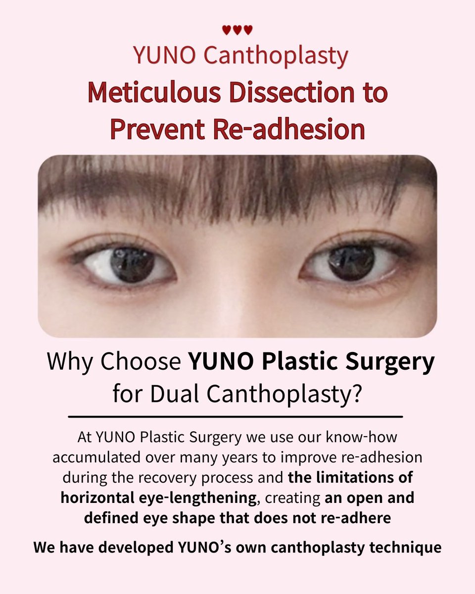 yuno_eng's tweet photo. ✨ Definite opening, without re-adhesion. 👁

YUNO Canthoplasty is customized to your eye shape and facial features for a clear, balanced, and natural-looking result

🤍📍 Yuno Plastic Surgery, Seoul
💬 KakaoTalk: yuno_ps
📱 WhatsApp: +82 10 2257 8670

#YunoPlasticSurgery https://t.co/NDYBeEipV3