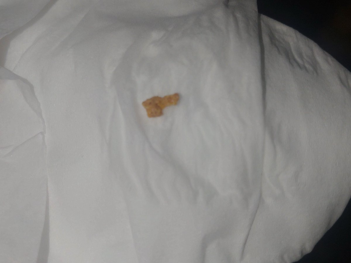 kurodou's tweet photo. 何日か前にちょっとオシッコが茶色寄りかな？って思ってたらなんか今日出てきた…全くの無痛で
俺もうこのサイズが無痛なんだ…（長いとこで８ミリくらい、多分縦になって出てきた） https://t.co/XoDR4Z12dE
