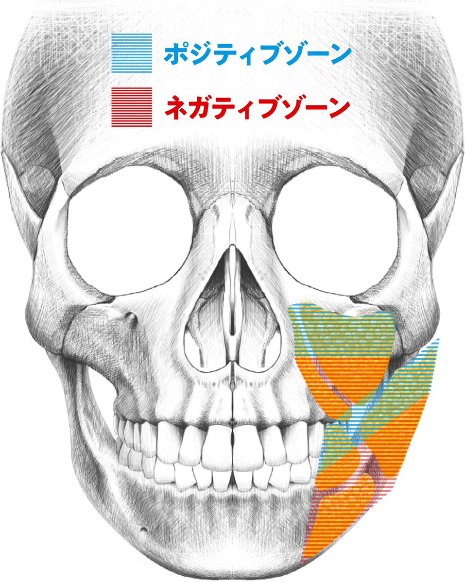 dr_asano_tomo's tweet photo. 【ANNAさんの輪郭になるための絶対条件💁‍♂️】

単に『脂肪を取る』だけでは絶対にこの輪郭にはなれません。
圧倒的爆美女の輪郭は「脂肪を根こそぎ取る」のではなく、「取るべき脂肪」と「残す(入れる)べき脂肪」を徹底的に見極めることで作ることができます。その鉄則が👇

❌取らない（ポジティブゾーン） ホホ上部／バッカル上部／メーラー上部 
👉 美女に必須の「中顔面の丸み」は死守。

⭕️しっかり取る（ネガティブゾーン） 
ホホ下部／バッカル下部／ジョール／メーラー下部 
👉 「下顔面の余白」を徹底排除しVラインへ。

なぜこれが重要なのか？ ポイントは顔の「重心」です。
脂肪の上部を残し、下部を適度に取り除くことで、顔の重心が上に移動し、全体がキュッと引き上がって見えます。

人が一瞬で『美人だ』と判断する基準は、目鼻のパーツ単体ではなく【余分な脂肪が無い、重心の上がった綺麗な輪郭かどうか】です。
単に脂肪を根こそぎ減らすのではなく、適切な「脂肪の配置」をデザインできる美的感覚を持ったドクターを選びましょう👌

この方は脂肪吸引と脂肪注入を組み合わせて卵輪郭に仕上げた方で脂肪除去量はさほど多くありません