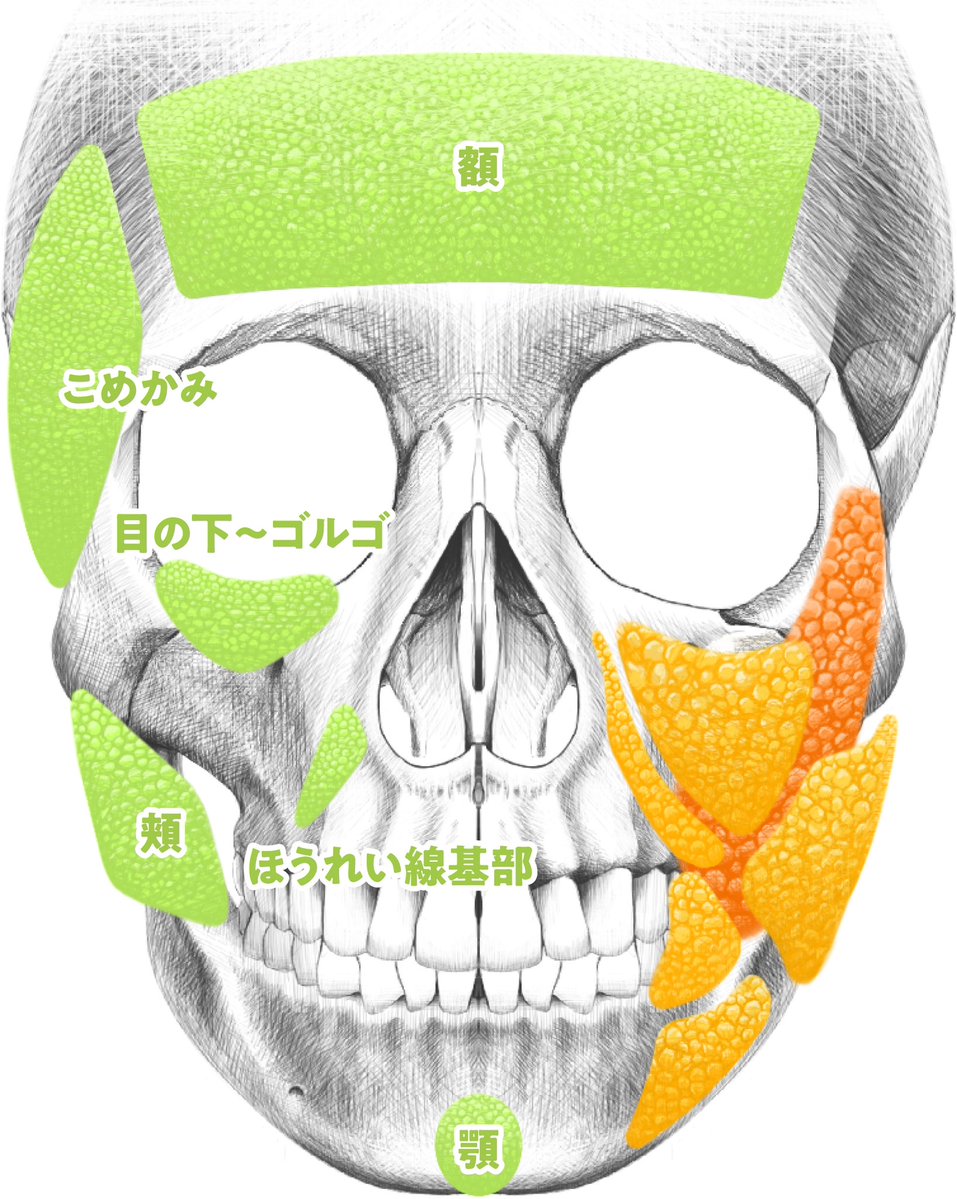 dr_asano_tomo's tweet photo. 【ANNAさんの輪郭になるための絶対条件💁‍♂️】

単に『脂肪を取る』だけでは絶対にこの輪郭にはなれません。
圧倒的爆美女の輪郭は「脂肪を根こそぎ取る」のではなく、「取るべき脂肪」と「残す(入れる)べき脂肪」を徹底的に見極めることで作ることができます。その鉄則が👇

❌取らない（ポジティブゾーン） ホホ上部／バッカル上部／メーラー上部 
👉 美女に必須の「中顔面の丸み」は死守。

⭕️しっかり取る（ネガティブゾーン） 
ホホ下部／バッカル下部／ジョール／メーラー下部 
👉 「下顔面の余白」を徹底排除しVラインへ。

なぜこれが重要なのか？ ポイントは顔の「重心」です。
脂肪の上部を残し、下部を適度に取り除くことで、顔の重心が上に移動し、全体がキュッと引き上がって見えます。

人が一瞬で『美人だ』と判断する基準は、目鼻のパーツ単体ではなく【余分な脂肪が無い、重心の上がった綺麗な輪郭かどうか】です。
単に脂肪を根こそぎ減らすのではなく、適切な「脂肪の配置」をデザインできる美的感覚を持ったドクターを選びましょう👌

この方は脂肪吸引と脂肪注入を組み合わせて卵輪郭に仕上げた方で脂肪除去量はさほど多くありません