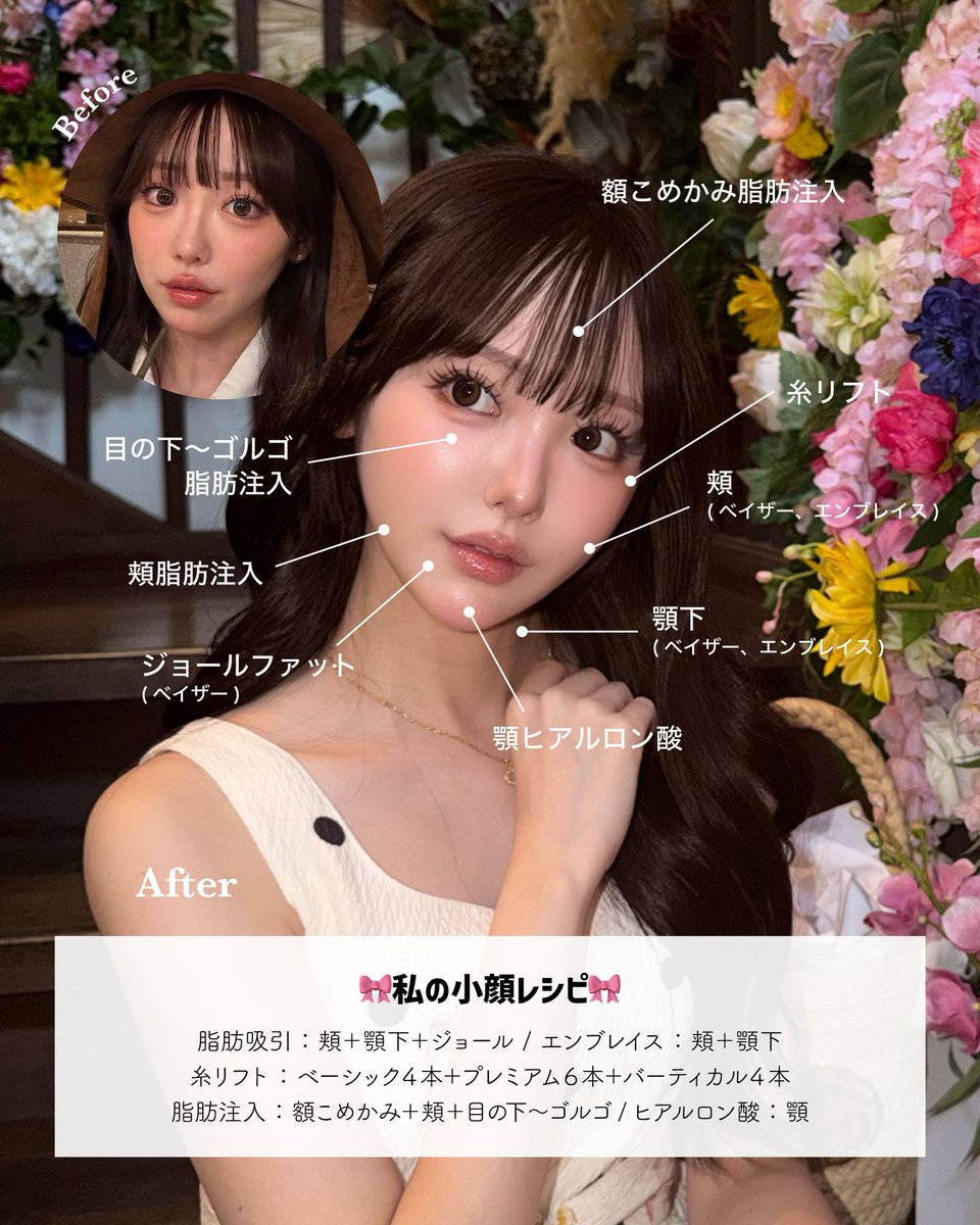 dr_asano_tomo's tweet photo. 【ANNAさんの輪郭になるための絶対条件💁‍♂️】

単に『脂肪を取る』だけでは絶対にこの輪郭にはなれません。
圧倒的爆美女の輪郭は「脂肪を根こそぎ取る」のではなく、「取るべき脂肪」と「残す(入れる)べき脂肪」を徹底的に見極めることで作ることができます。その鉄則が👇

❌取らない（ポジティブゾーン） ホホ上部／バッカル上部／メーラー上部 
👉 美女に必須の「中顔面の丸み」は死守。

⭕️しっかり取る（ネガティブゾーン） 
ホホ下部／バッカル下部／ジョール／メーラー下部 
👉 「下顔面の余白」を徹底排除しVラインへ。

なぜこれが重要なのか？ ポイントは顔の「重心」です。
脂肪の上部を残し、下部を適度に取り除くことで、顔の重心が上に移動し、全体がキュッと引き上がって見えます。

人が一瞬で『美人だ』と判断する基準は、目鼻のパーツ単体ではなく【余分な脂肪が無い、重心の上がった綺麗な輪郭かどうか】です。
単に脂肪を根こそぎ減らすのではなく、適切な「脂肪の配置」をデザインできる美的感覚を持ったドクターを選びましょう👌

この方は脂肪吸引と脂肪注入を組み合わせて卵輪郭に仕上げた方で脂肪除去量はさほど多くありません