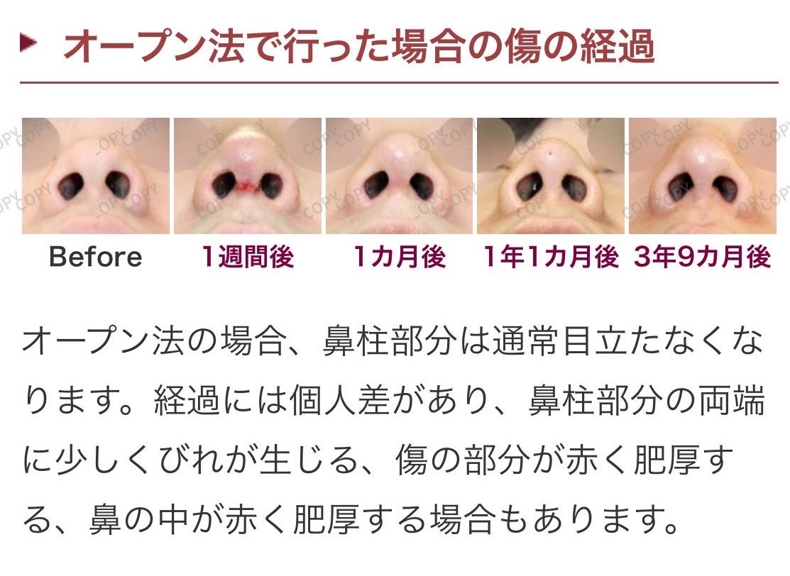 hillsclinic's tweet photo. 鼻尖形成　オープン法の傷あとの経過

さすがに術後約4年の経過写真はないやろ

検診にきてくれた患者さんに感謝よ https://t.co/oubEsCJl18