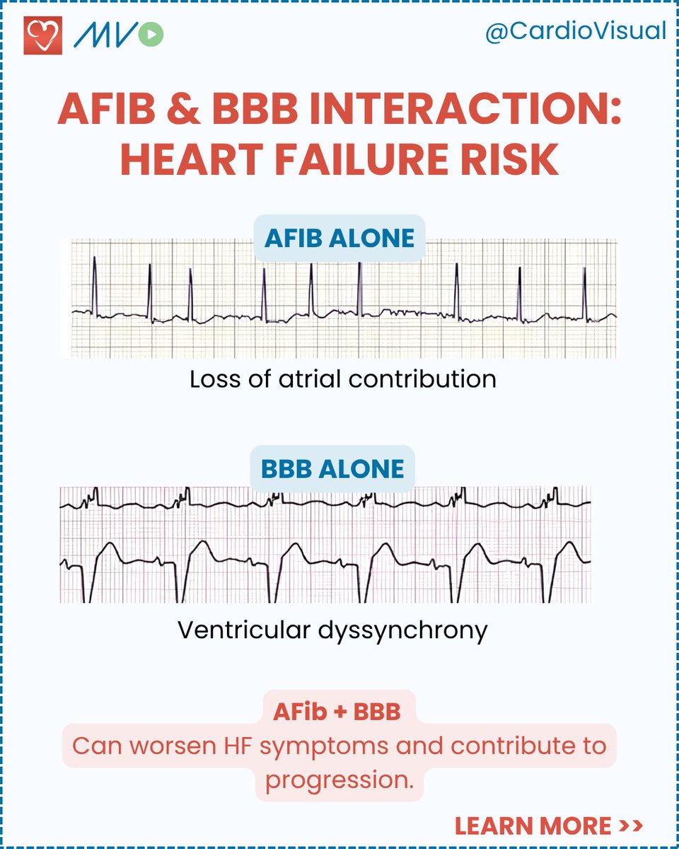 CardioVisualApp's tweet photo. Atrial fibrillation + bundle branch block can alter conduction, hemodynamics, and management. Learn to identify both on ECG with Matt Holden from Scope Education, only on Clinician Hub: https://t.co/ju8HkHJWL9
#Cardiology #ECG #AFib https://t.co/5Rb4ijvZH6