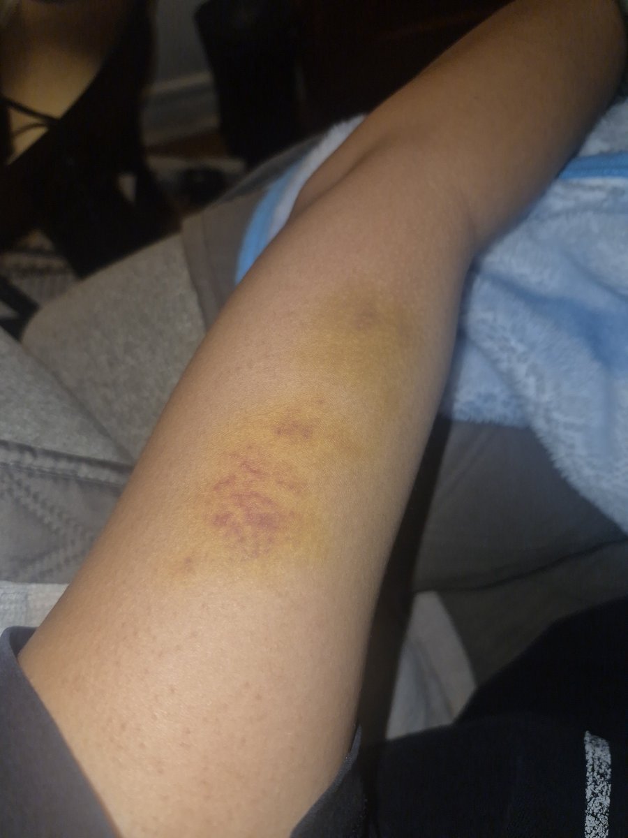 tinypupgal's tweet photo. need to redo these bruises again soon :P https://t.co/RSQXQ3vo06