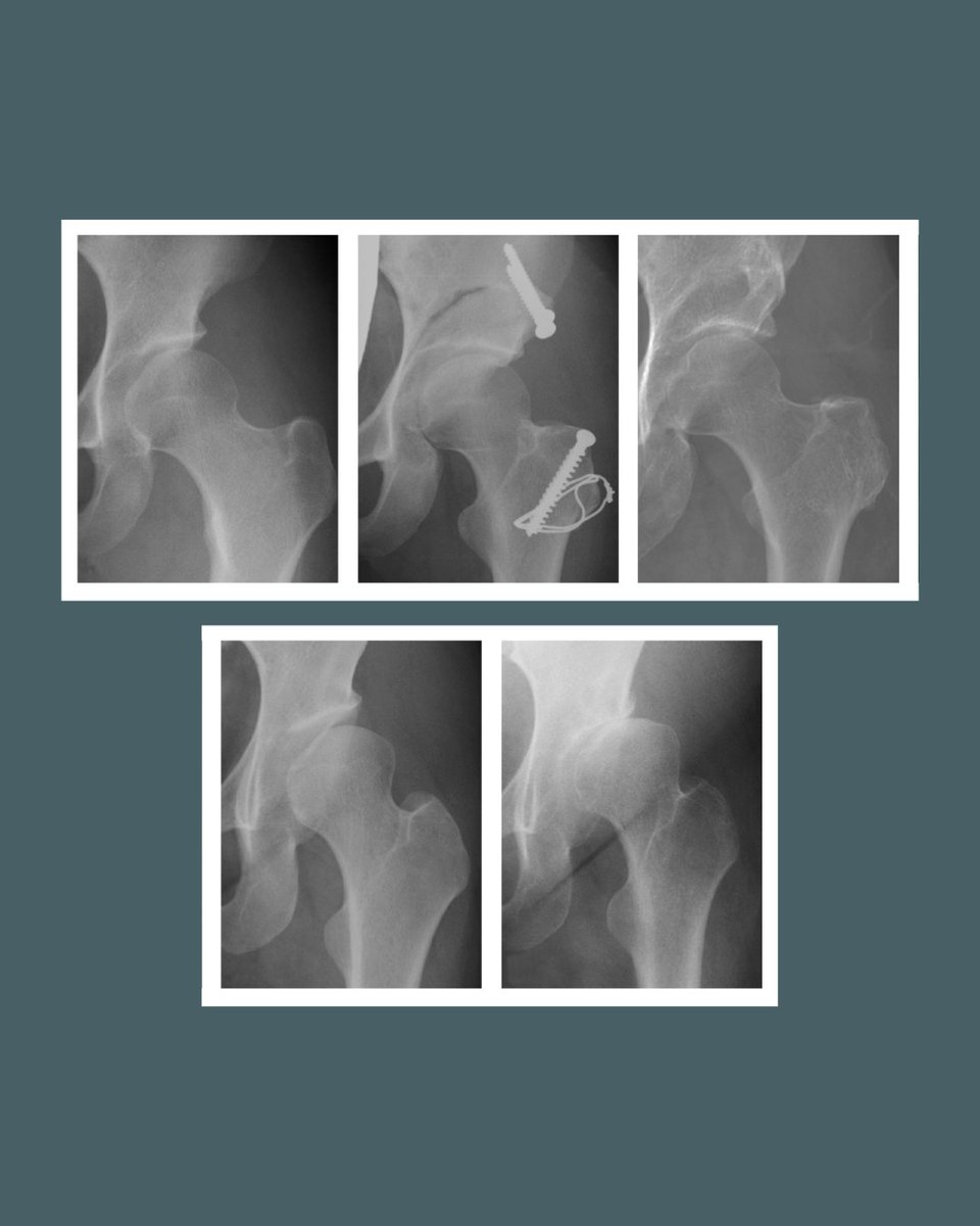 BoneJointJ's tweet photo. In native hips, the 20-year survival was significantly lower in DDH than in borderline DDH and normal hips, with no significant difference between borderline DDH and normal hips.
#DDH #HipDysplasia #Osteoarthritis #Osteotomy
https://t.co/l3P61pe69b https://t.co/diZcXSZ8LY
