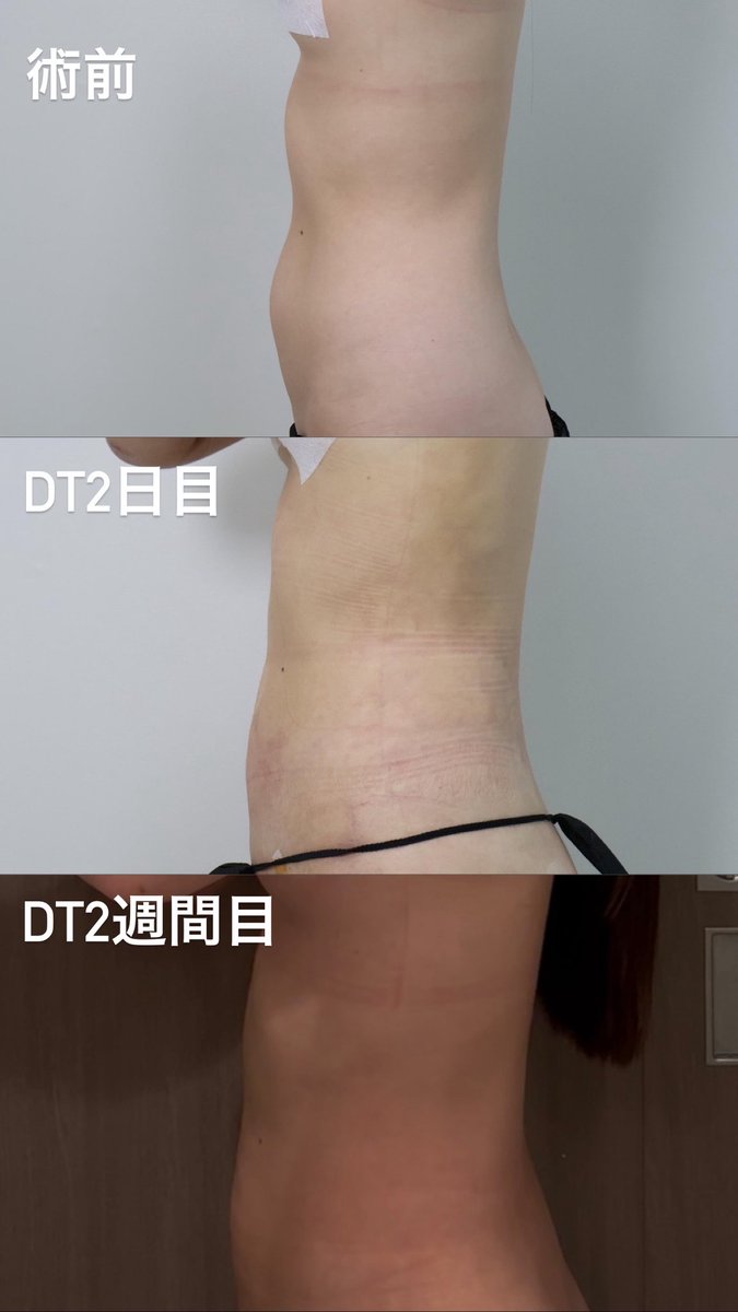 anagoryan's tweet photo. @delight_ps_jp で二の腕と腹部の脂肪吸引をして2週間が経ちました。10日ほど経つと楽になりましたが、まだ髪を結んだり横向きで寝ることはできません。インディバを始めてから可動域が広がったので引き続き通います。腫れはあるものの、細くなってて満足です🥹
#二の腕脂肪吸引
#腹部脂肪吸引 https://t.co/CJQ992Af8f