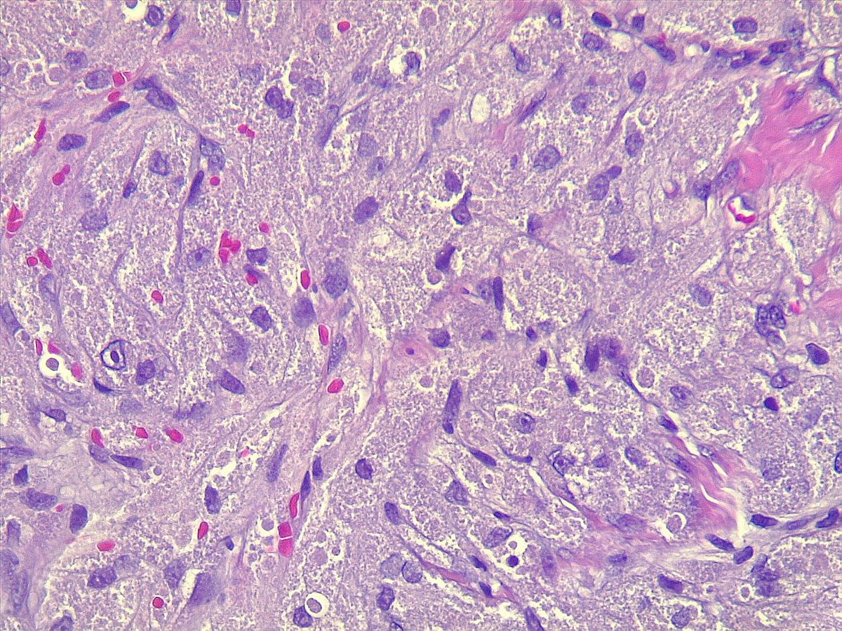 ariabdullah1978's tweet photo. Young boy with a tongue mass, can't be any more clear, or should I say granular!!?
#PathX https://t.co/PXS3HipRsQ