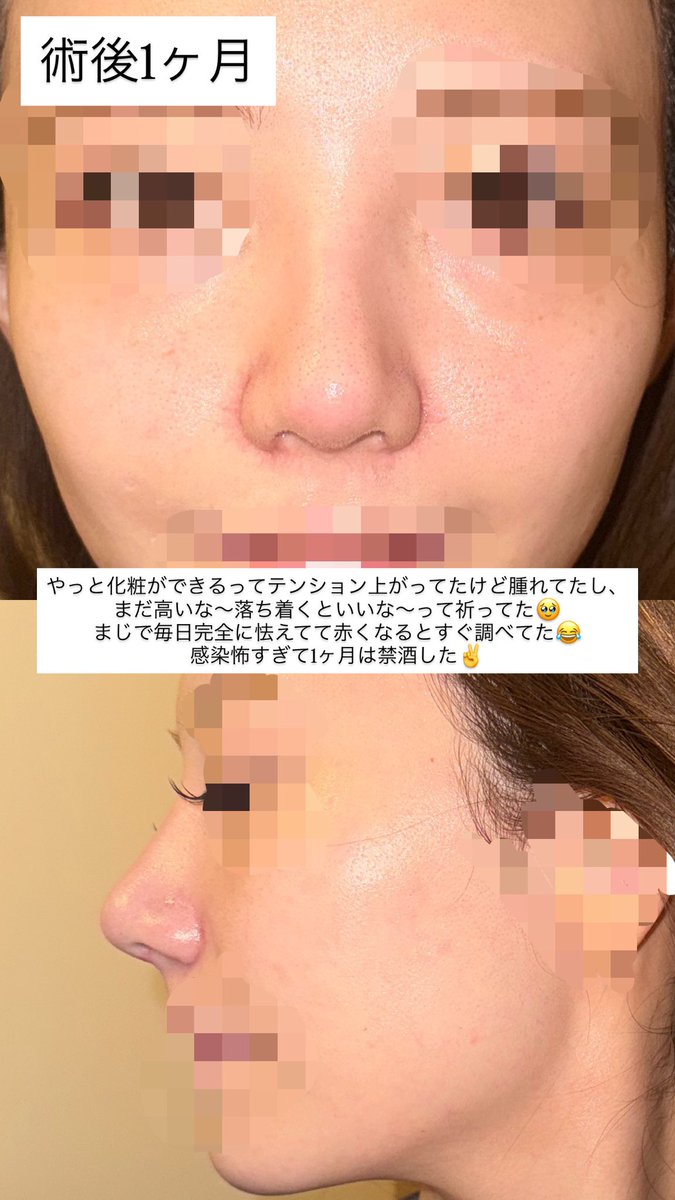 complex_sacai's tweet photo. 鼻フル術前〜1年後まで並べてみた👃🏻(1/2)
自家肋で鼻フルして、結局どれくらい馴染んだ／後戻りしたのか記録✍🏻📗

術直後の高さからはもちろん馴染んだけど、半年以降は大きく低くなった感覚はなし。
正面は自然になって団子鼻も解消されたし、横顔の鼻筋〜鼻先と鼻柱の出方は今もお気に入りで嬉しい🥹

毎日毎日写真撮って、低くなった？鼻先丸くない？後戻り？って毎日のように写真比較してた😂
こうやって1年分並べると変化分かりやすいかも。

自家肋にした理由とか、DT中の生活とか自分の記録用としても気分で載せていけたらいいな✏️

※肌のみ加工、鼻の形加工なし

 #鼻フル 
 #鼻整形
 #渡韓整形