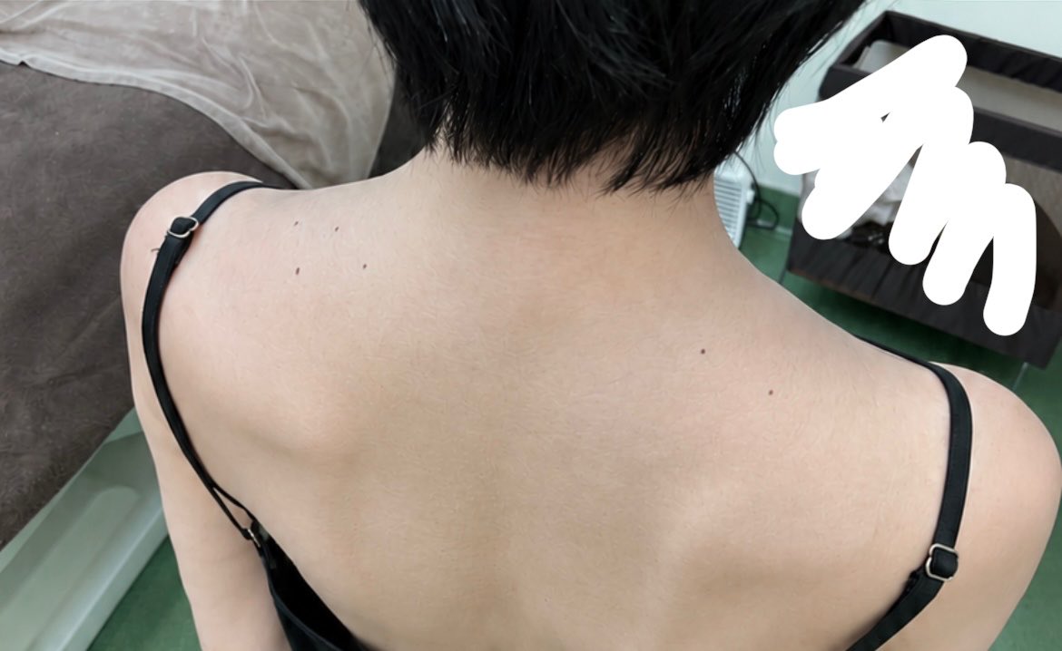 y_seikeiol's tweet photo. 首長くしたい人、肩に爆弾抱えてる子、肩ボト効かなかった子‼️
まだ肩ボトで夢見れる可能性ある‼️‼️

ワイもデスクワーク歴10年以上でごっつい肩だったんだけど、今回覆されるかも🥺

日本で肩ボト打つならドクター松井👨‍⚕️って言われてうん十年。ようやく行ってきましたが先生がデーターベースすぎたwww

スパイしてるみたいで嫌だけど流石に有益すぎたから聞いてくれ。

👨‍⚕️『ボトだけでは不十分。本気で効果あげたいならボトが効いてる間にほぐさないとダメ』

だそうです。

何やればいいかと言うと
・鍼（1週間後から）
・マッサージ（1週間後から）
・温活（4日後から）

とのこと。え？？？早よ言って？？？
もしかして知らなかったのワイだけ？
みんな知ってて普通にやってる？

ワイは普通に肩ボト打って終わってただけだが。
というか、ボトの効果切れると思って色々やるの辞めてたんだが😂

ってことでそれ聞いて今回打ってもらったのがこんな感じ✨
先生は固めで真面目な感じなのかと思ってたし実際そうだったんだけど、博識すぎて色々知りたかったのでバカ話しかけてしまった笑笑

あと首ボト打ちたかったけど『グラグラになるリスクがあるから僕はあんまりオススメしたくない』とのことでかなり保守的。

マーキングも丁寧だし、肩ボト200単位も効くように打ってくれたけど痛くないし過去一良かった！あとは効果が出てくれれば最高✨また載せるね。

あと先日、話題になってた気胸のことだけど、普通に背面に肩ボトしてる分にはならないと思うとのことでした。ボト打つ時の針はそんなに長くないし、背中に鍼したなら考えられるけど肩ボトでなるかなぁとのこと。

余談🍵なんで肩ボトと言えばドクター松井って言われてるのか分からなくて、先生にも『なんでここってこんなに有名なんですか？』って聞いちゃったけど（おい）、分からないとのことでした。口コミかなぁ……？みたいな感じ。

耐性付かないボトックスも置いてあるから、整形上級者・メンテ上級者にも重宝されてるのわかる。
ていうか、名前的に近所の小さい皮膚科みたいなところを想像してたけど普通に部屋の数多いしシンプル綺麗。

ここで効果出なかったら、肩ボト辞めるのでよろしくお願いします。何卒何卒……🖐️