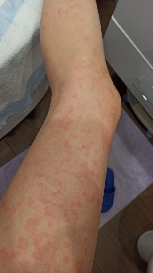 PhillisKhobjko's tweet photo. 昨晚刚在男朋友家睡完 今儿身上居然冒出这玩意儿 到底是啥呀有人懂么 https://t.co/jJgrdtW1Rz