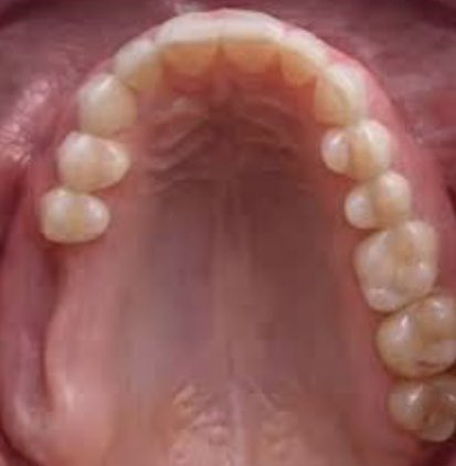 justsmiledc's tweet photo. DO YOU HAVE A MISSING TOOTH/ TEETH?

All you need is a dental prosthesis; which can be a denture, an implant, or bridge. 

IMPORTANTS OF A DENTAL PROSTHESIS:
1. Restores oral function; you would be able to have an equal bite on both sides of your mouth, chew and eat properly. https://t.co/nHFKLJhqqt
