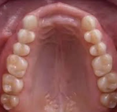 justsmiledc's tweet photo. DO YOU HAVE A MISSING TOOTH/ TEETH?

All you need is a dental prosthesis; which can be a denture, an implant, or bridge. 

IMPORTANTS OF A DENTAL PROSTHESIS:
1. Restores oral function; you would be able to have an equal bite on both sides of your mouth, chew and eat properly. https://t.co/nHFKLJhqqt