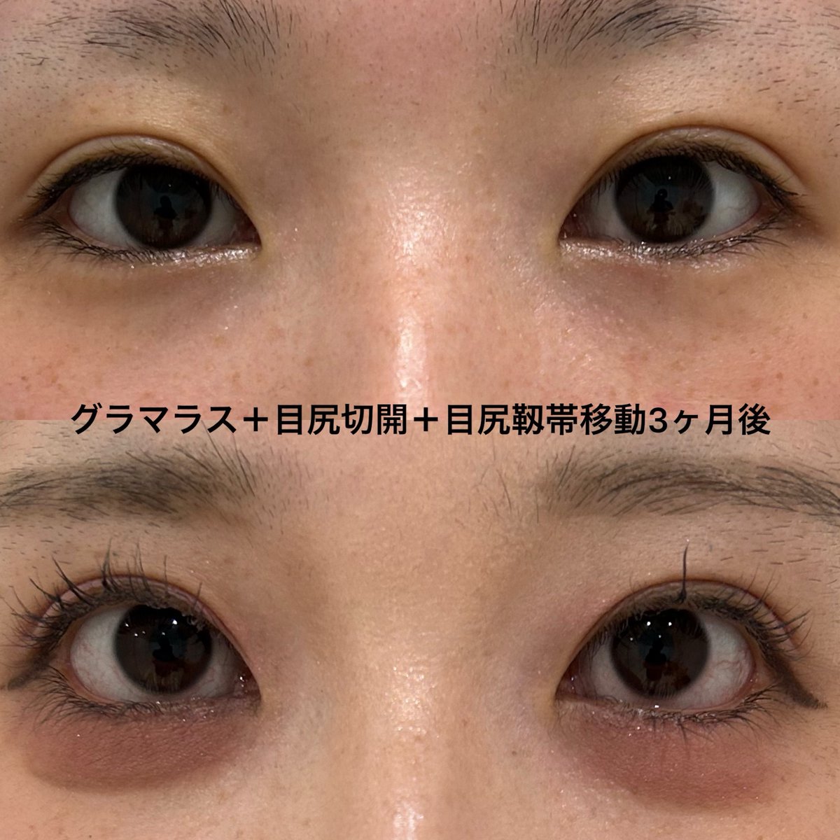 eternalprince08's tweet photo. 自然に目を大きくしたい、左右差を改善したいご希望でした

左の方がやや下瞼のカーブが急であり、左を少し強めに下げて左右差を整えました

 #エターナルクリニック
#たれ目形成 https://t.co/jdONvZU7kH