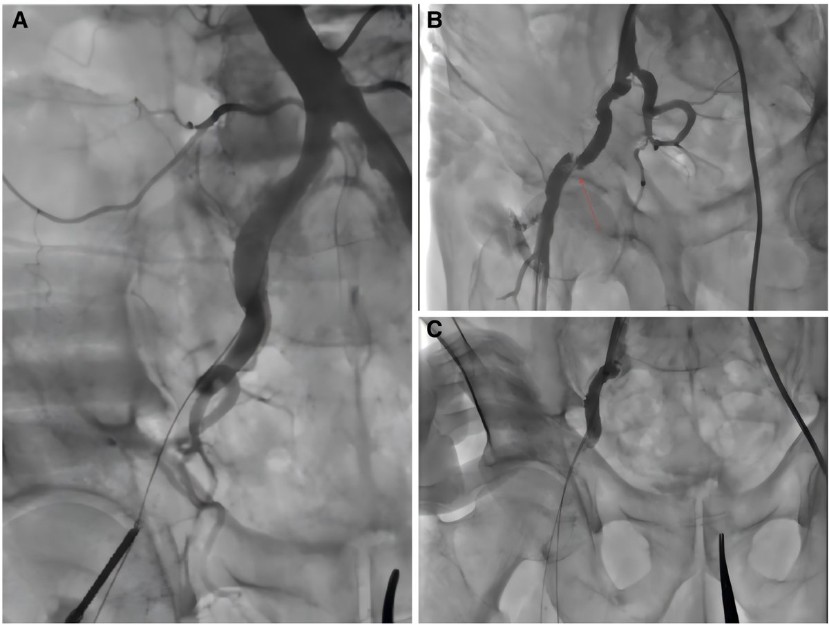 ESC_Journals's tweet photo. Be vigilant of tortuous femoral arteries while using vascular suturing devices - iatrogenic vascular stenosis is a possible complication https://t.co/Ag47tQ1pCP
#EHJCaseReports @Phiso_de @TJ_Yeo @girishviswa @sukritibanthiya @O_Azizy_MD @saramoscatelli7 @EHJCREiC #CardioX https://t.co/SOI6pl1qtF