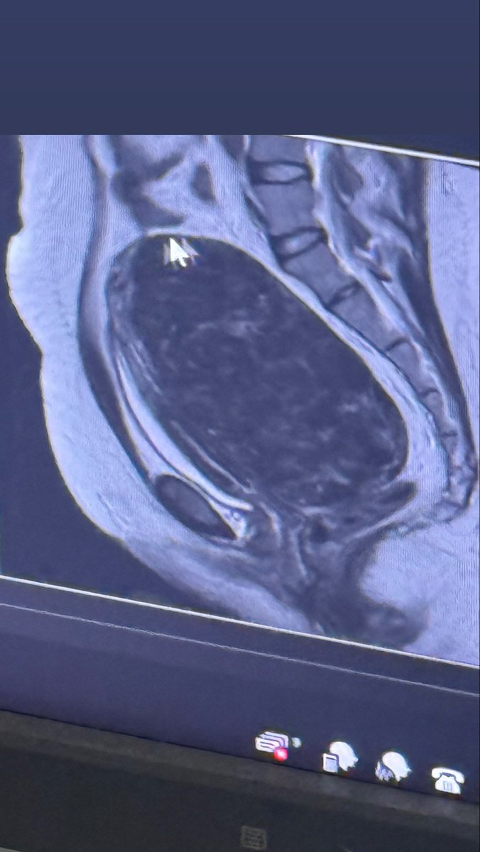 LookAtLollyy's tweet photo. Tumors are finally gone from my stomach 😩🙏 https://t.co/gUlB4xc6Zu