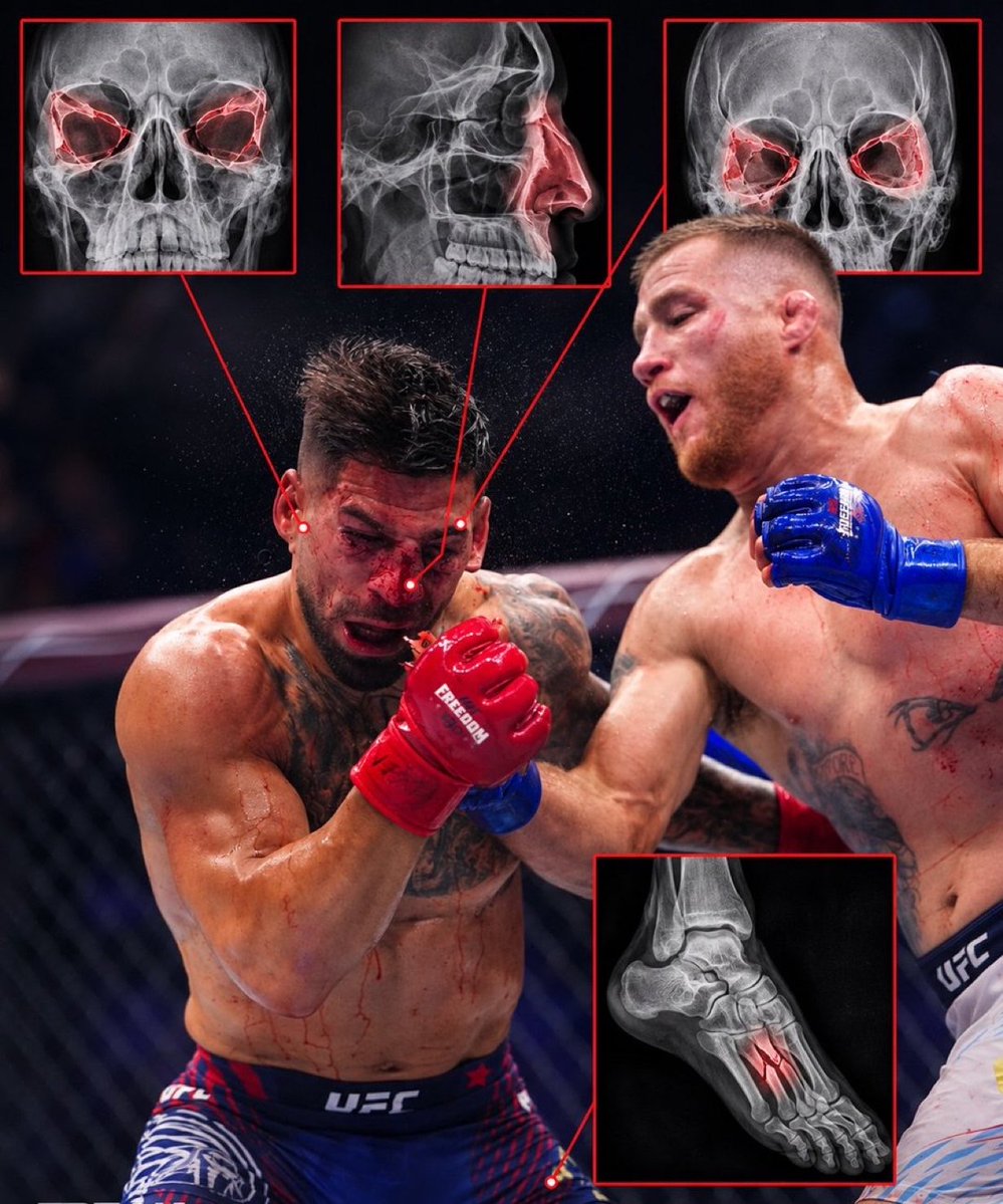 KirmiziKoseMMA's tweet photo. 🚨 Ilia Topuria, Justin Gaethje maçı sırasında iki göz çukurunun da kırıldığını, burun kemiğinin kırıldığını ve ayağının parçalandığını doğruladı. 👀

Topuria: “O gece sporun daha önce hiç bilmediğim bir yönünü de deneyimledim: iki göz çukurum da kırıldı, burun kemiğim kırıldı ve ayağım parçalandı.”