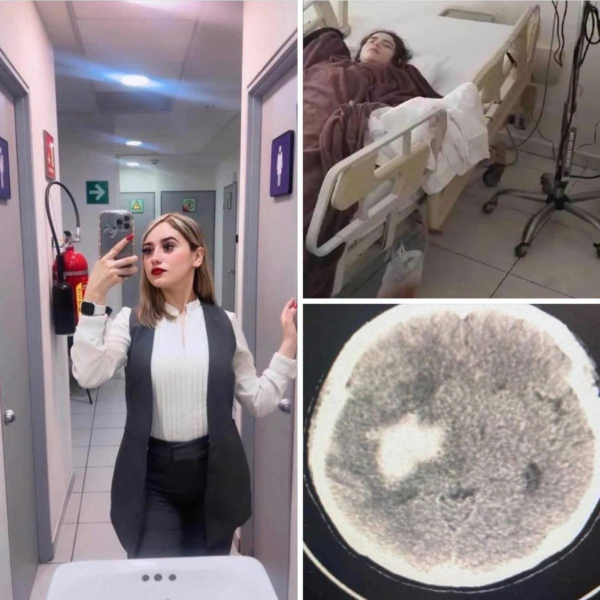 VigiaCiudadano7's tweet photo. #LAMENTABLE🥺🚨🕊️Un día estás en el trabajo siguiendo tu rutina bien, a  las horas siguientes estás internada en un hospital por un derrame cerebral luchando por tu vida, con el lado izquierdo paralizado y la vista afectada. 
Siendo jovenes nos creemos invencibles, no pensamos en nuestra salud; Cuídense porque el cuerpo te cobra factura por los nervios, la tristeza, el estres, la preocupación... Por todo.

No se desvivan por ninguna persona, trabajo, por nada, amen y valoren su persona sobre todas las cosas. ❤️‍🩹🙏🏻
