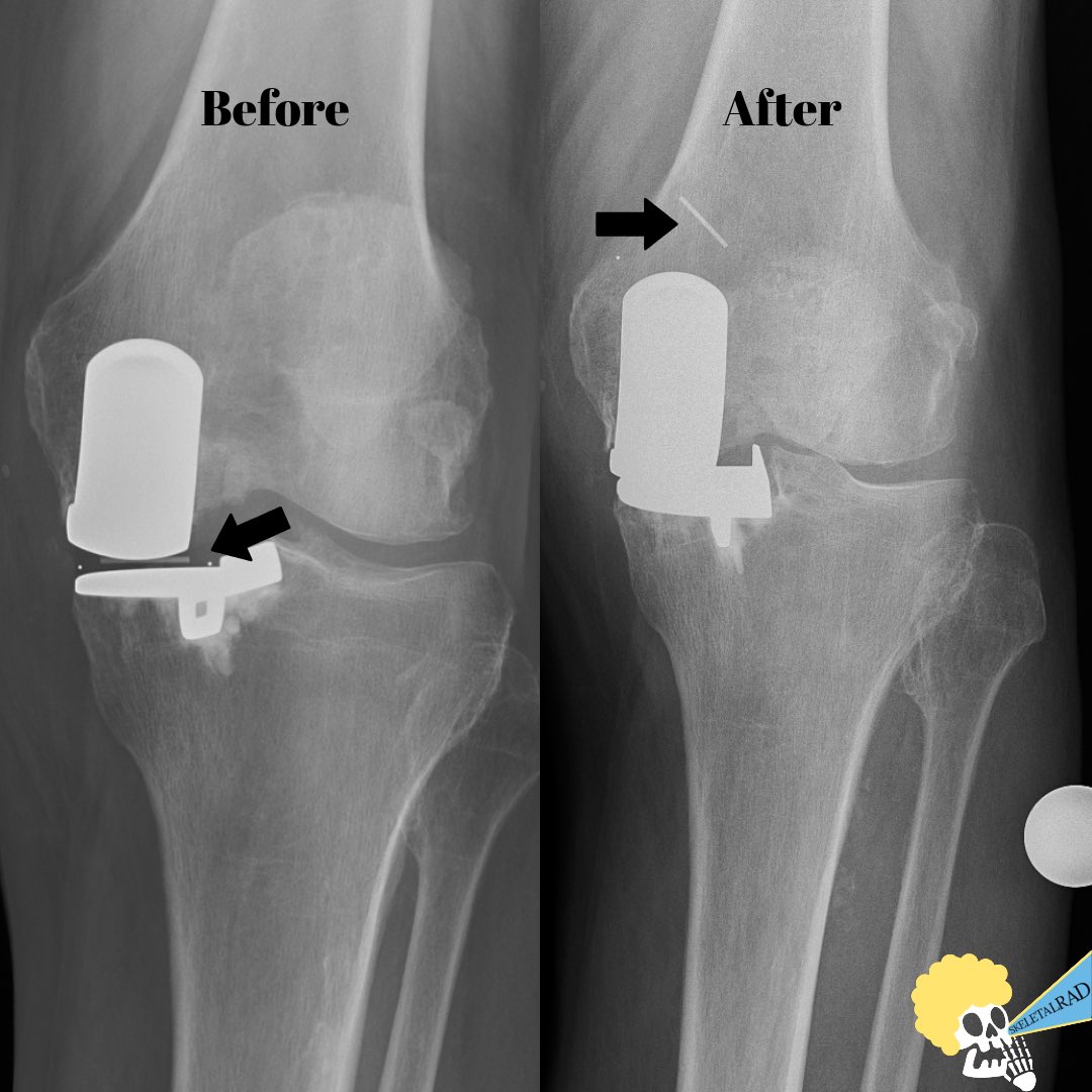 skeletalrad's tweet photo. Where is that thingy? 

A dislocated polyethylene insert/bearing. https://t.co/ihicwanNsz