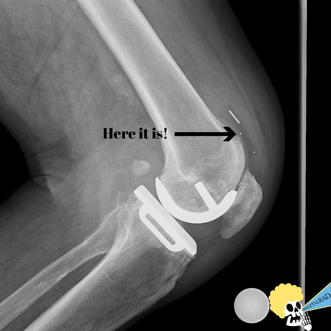 skeletalrad's tweet photo. Where is that thingy? 

A dislocated polyethylene insert/bearing. https://t.co/ihicwanNsz