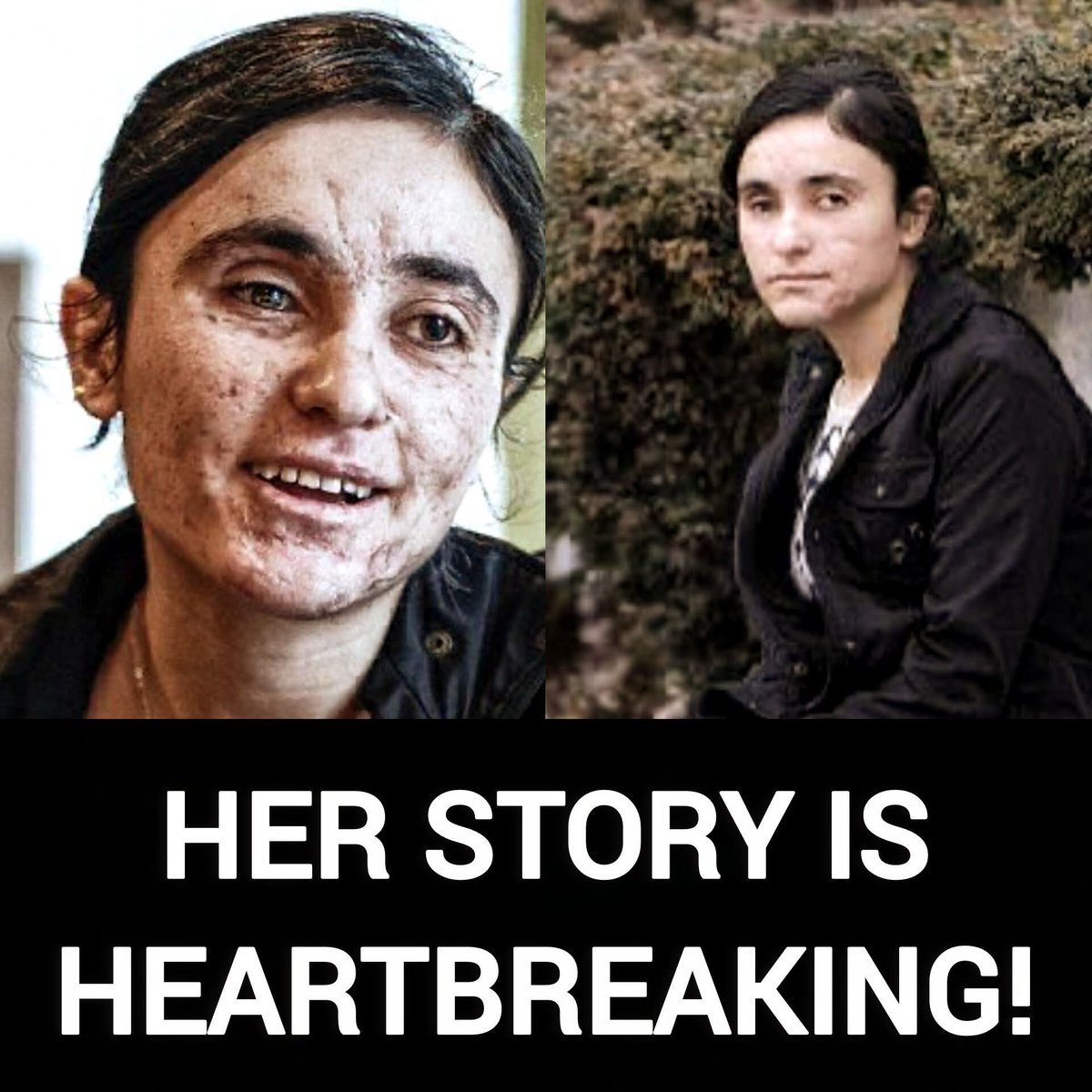 DavidJHarrisJr's tweet photo. A young Yazidi girl, kidnapped, repeatedly raped, tortured, and burned by ISIS monsters.

Her scarred face exposes the demonic savagery of ISIS against innocent Yazidi women.

The world must stop ignoring this genocide. https://t.co/8kjXyUJm6z