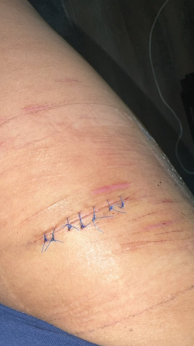 Yurisohoated's tweet photo. My stitches so far! The second photo, I already cleaned it🥹 https://t.co/BzpcxzccO7