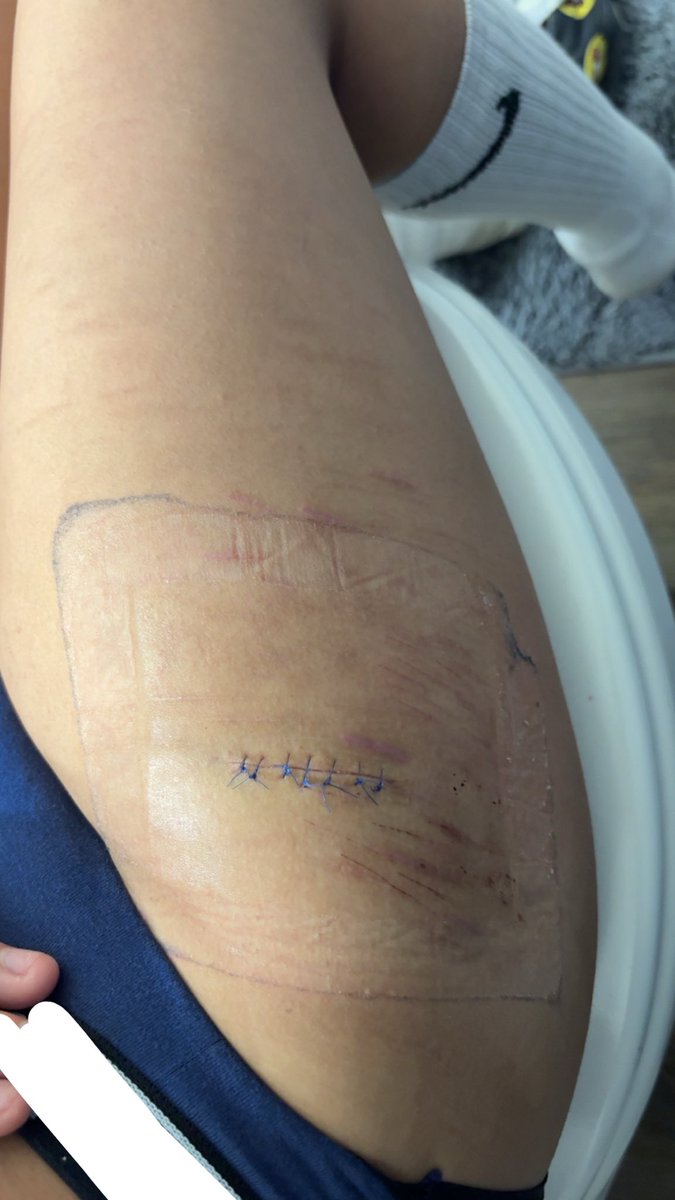 Yurisohoated's tweet photo. My cuts/scars so far🥹✌️ https://t.co/QyM6R48D8A
