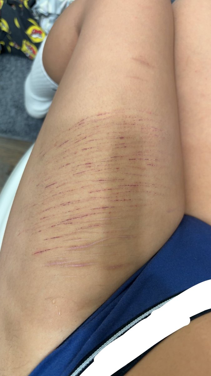 Yurisohoated's tweet photo. My cuts/scars so far🥹✌️ https://t.co/QyM6R48D8A