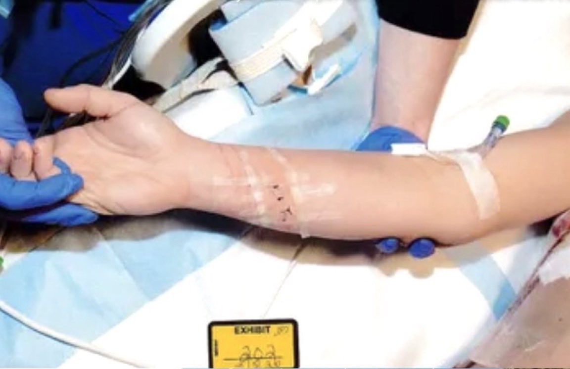 Daniellavromeo's tweet photo. I’m genuinely in disbelief. Here is the photo evidence of Lindsay Clancy’s “slitting her wrists” suicide attempt. She could’ve stabbed herself with a kitchen fork and we wouldn’t be able to tell the difference. The knife Lindsay used was gigantic and sharp, yet this is the cut she made. It’s worth repeating that Lindsay is a nurse, and is 100% aware of the type of cut, in which location, and at what depth would be needed in order to kill herself or someone else. She had also successfully completed the methodical strangulation murder of her 3 children just moments before her “attempt.”

Lindsay Clancy did not attempt suicide. She intentionally made it look like she tried, and fully planned to come out alive. Every step she took that day was calculated and deliberate. Her only failure was not knowing how to drop from a 2 story window unscathed. 

She was not in psychosis, she was simply done with her children and consciously chose this plan as her escape hatch. Life in prison without parole. There is no other acceptable outcome.