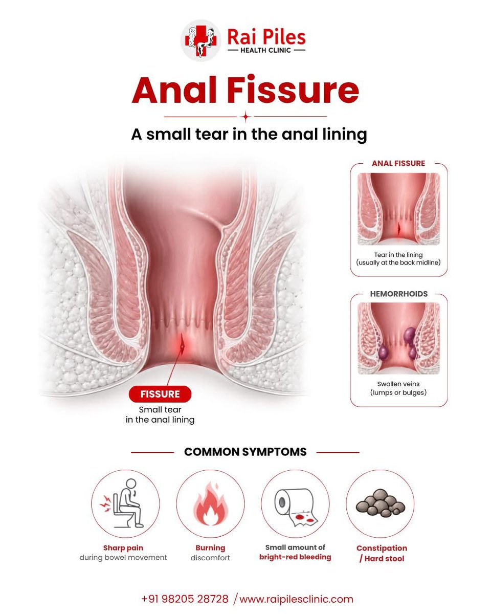 raipiles's tweet photo. 😖 Sharp pain during bowel movements + blood on tissue? It might be an Anal Fissure — a small tear often ignored until it becomes chronic.
Dr. Yogendra Rai (Rai Piles Hospital) advises: Timely diagnosis &amp; the right treatment can heal it without surgery in most cases! 🩺✅ https://t.co/I5H04QOw9d