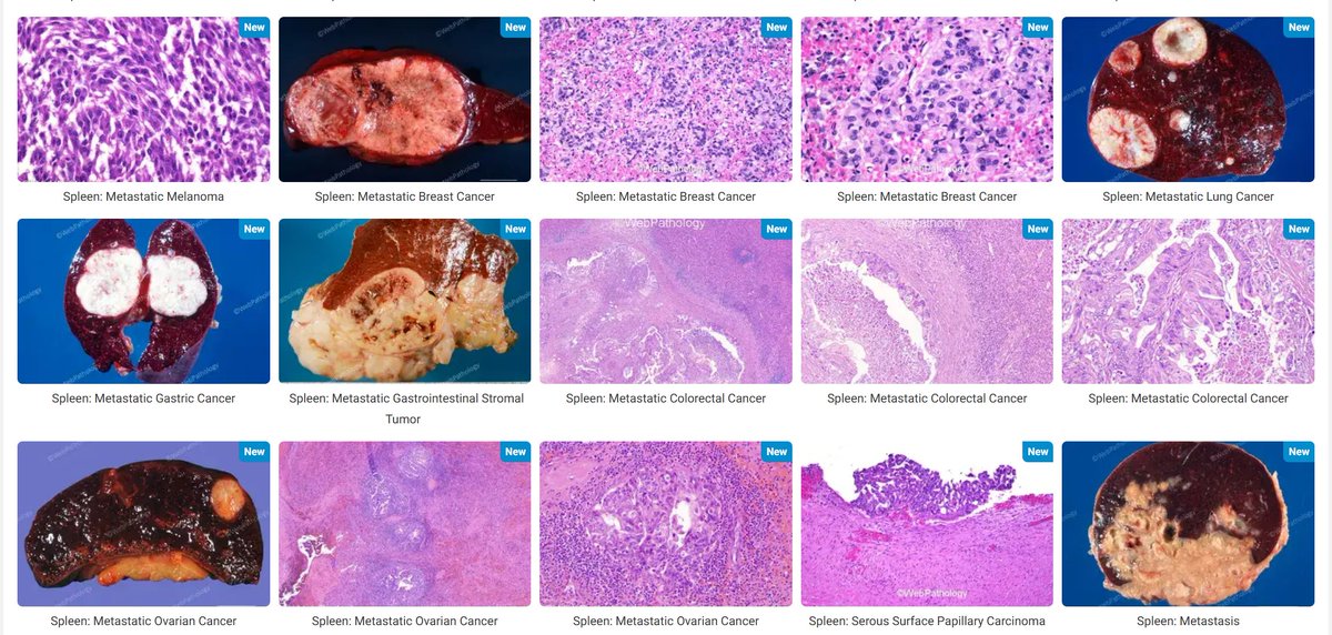 WebPathology's tweet photo. Update in #Spleen #Pathology - Metastases to Spleen; 30 images. #hemepath https://t.co/HixZRmDfXq https://t.co/4fIfGrAf4G
