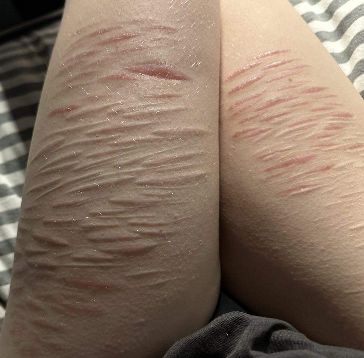 asheeenxi's tweet photo. Old scar check I found this pic and I like it idk why i havent posted it before👀

(dont snipe me twt these are HEALED scars, discouraging not encouraging! Healed scars look better than fresh cuts dont cut guys) https://t.co/wyOOeKSb2M