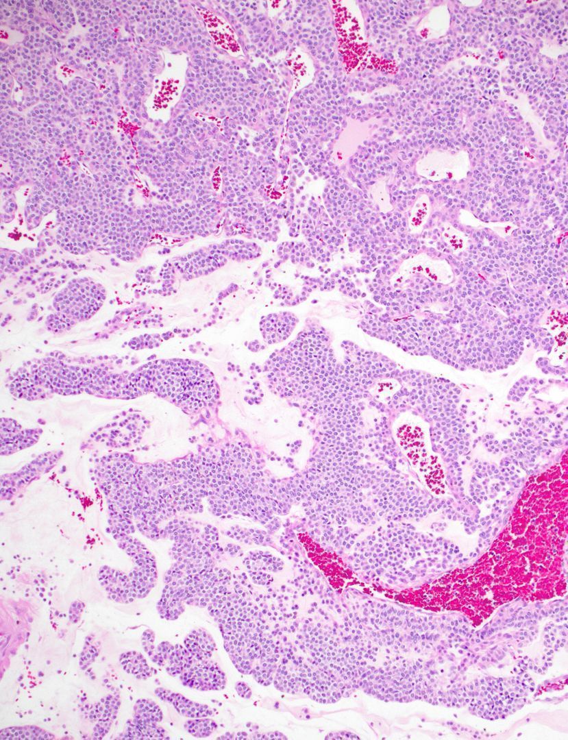 JMGardnerMD's tweet photo. Stomach wall mass. Can you make diagnosis from one pic, or is it #TooCloseToDiagnose? 
Answer ✅ https://t.co/2Bc1Wk5PPt 
More pics: https://t.co/qaAuUlJjQq 
#GIpath #pathologists #pathology #BSTpath #pathTwitter https://t.co/IxtxtxZ0i2